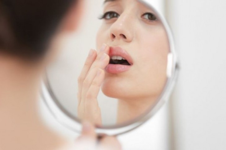 Herpes na usni – kako najbrže do zdrave kože